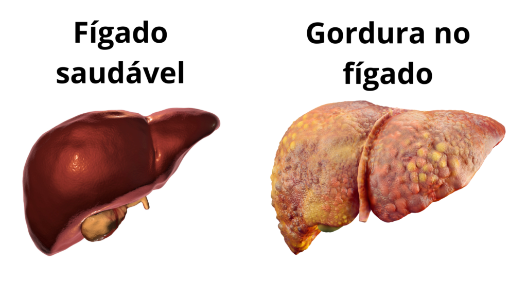 gordura no fígado